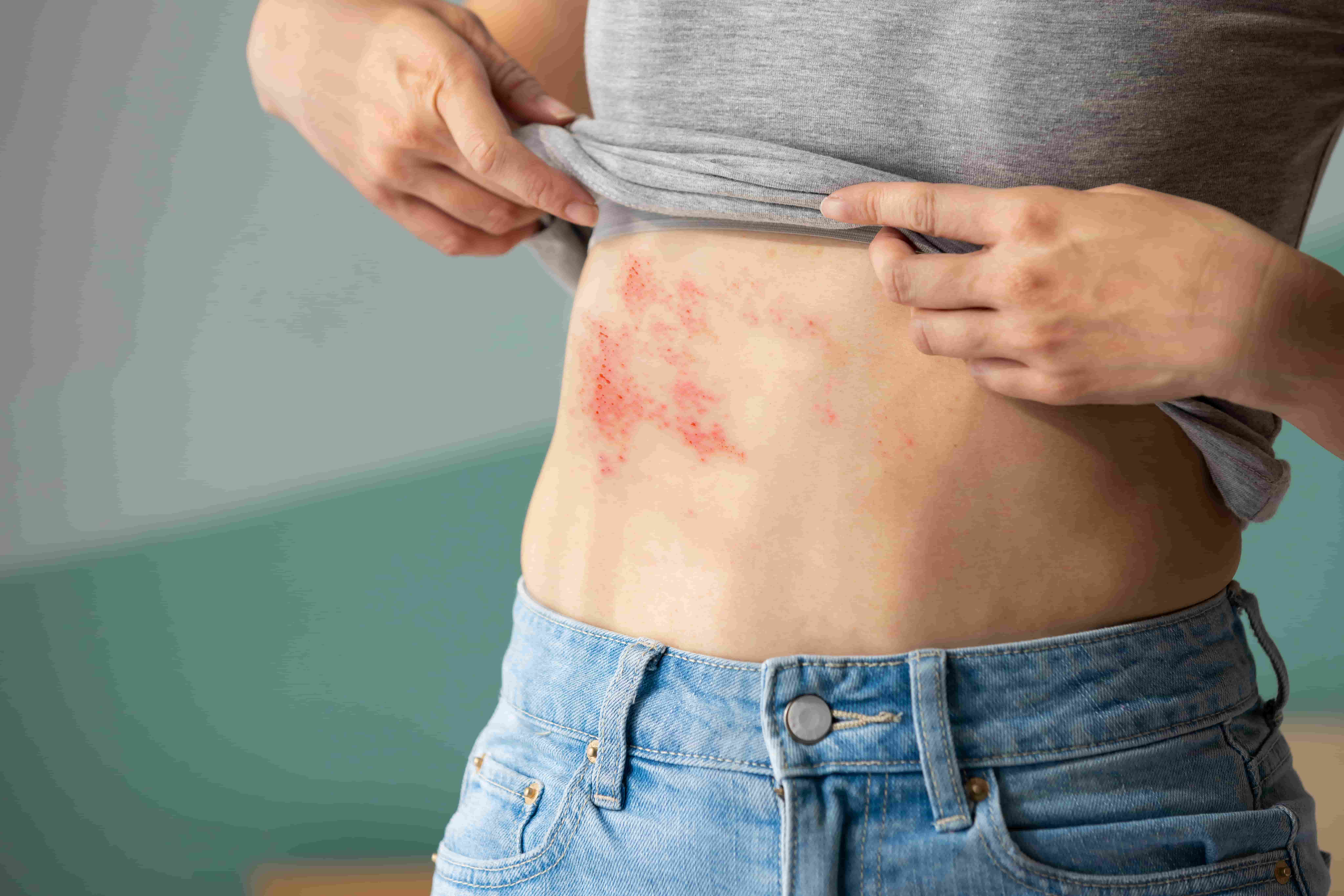 Asian Travel Fatigue? Identifying and Managing Shingles