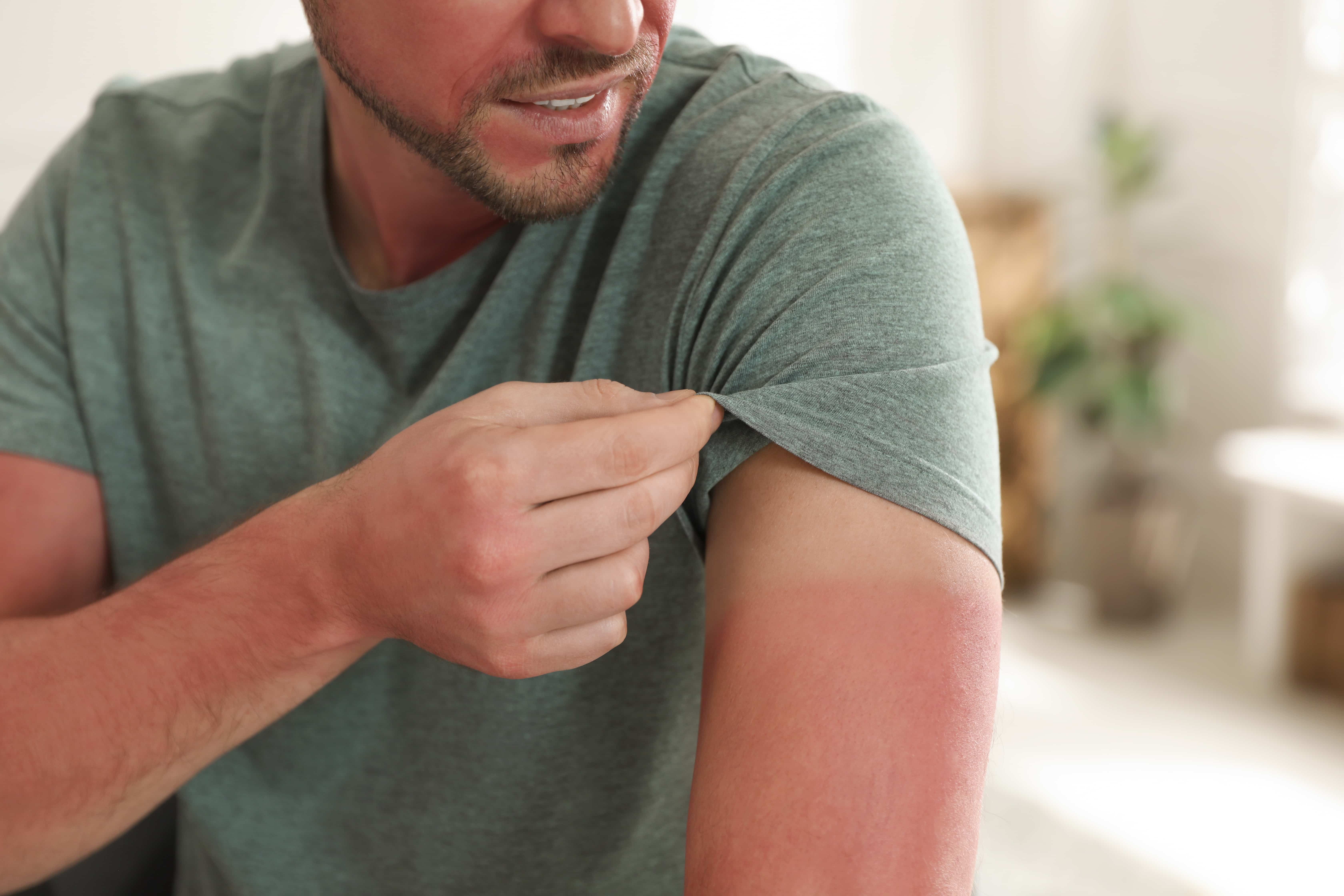 Tourist with sunburn on arm after sightseeing in Japan, comparing red skin reaction